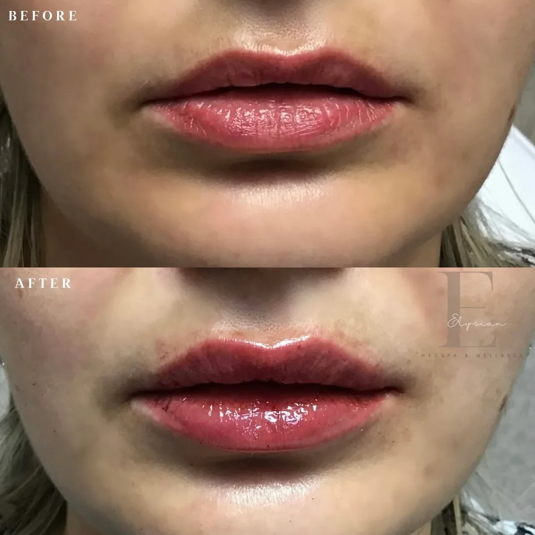 Lip filler before-and-after photographs