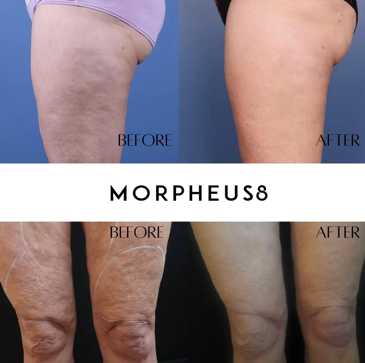 Morpheus8 treatment gallery image 3