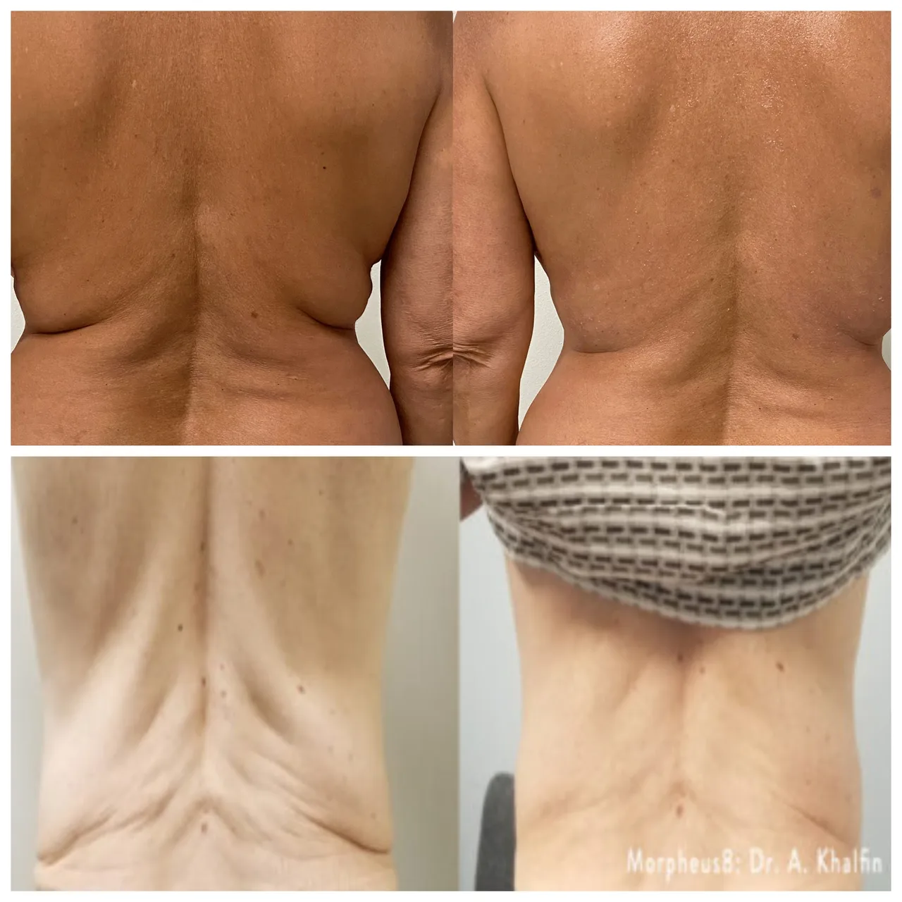 Morpheus8 treatment gallery image 1