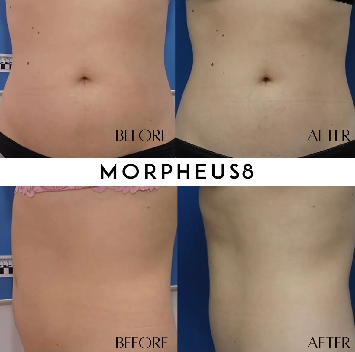 Morpheus8 treatment gallery image 2