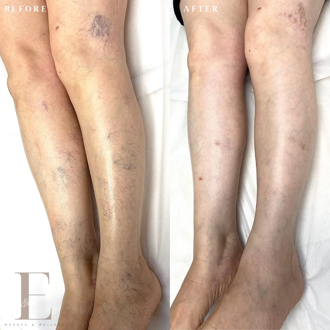Spider vein treatment before-and-after photographs